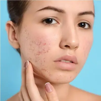 Acne Scars Treatment: Ice Pick, Boxcar and Rolling Scars Explained: illustrative photo