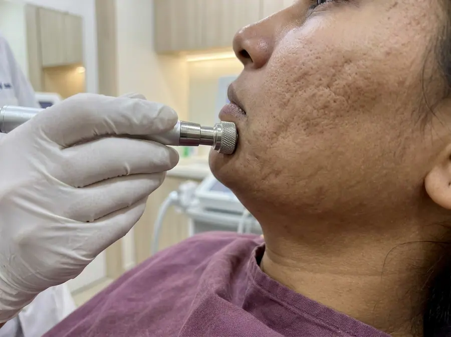 A doctor using a small spinning dermabrasion instrument on a woman's chin (illustrative photo)