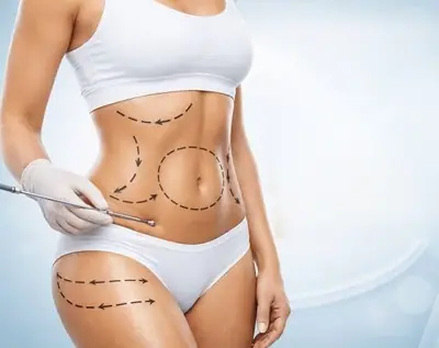 A doctor examining fat on the side of a woman's waist (illustrative photo)
