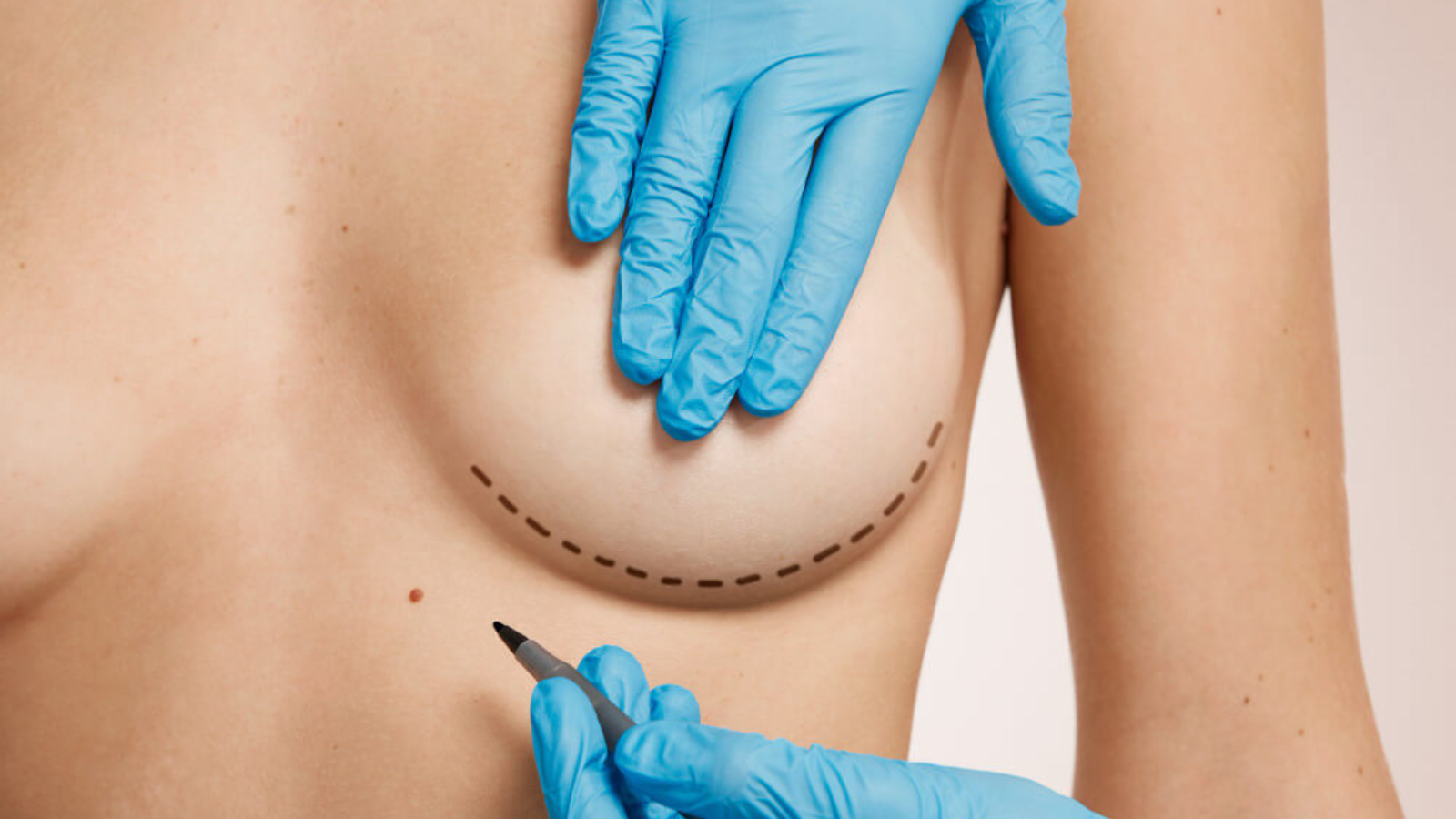 Breast Implantation