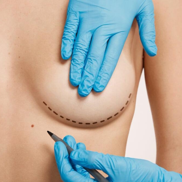 Breast Implantation