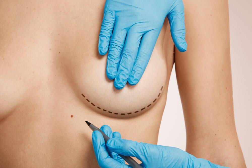 Breast Implantation