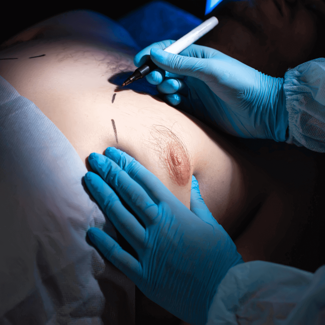 Gynecomastia Home