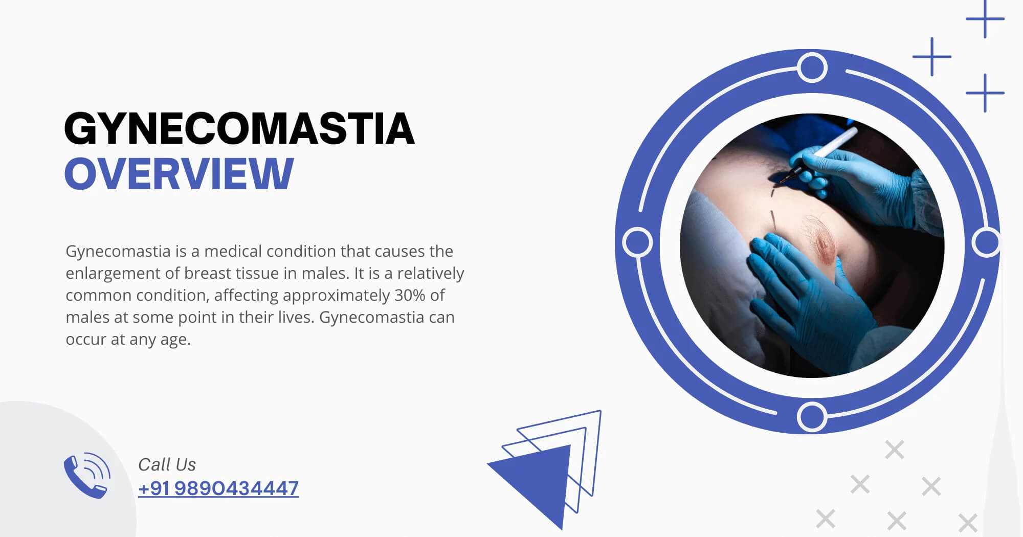 Gynecomastia-Overview-Dr-Service