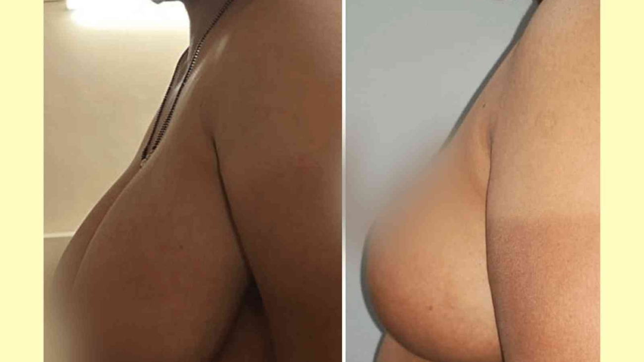 Breast Reduction Surgery