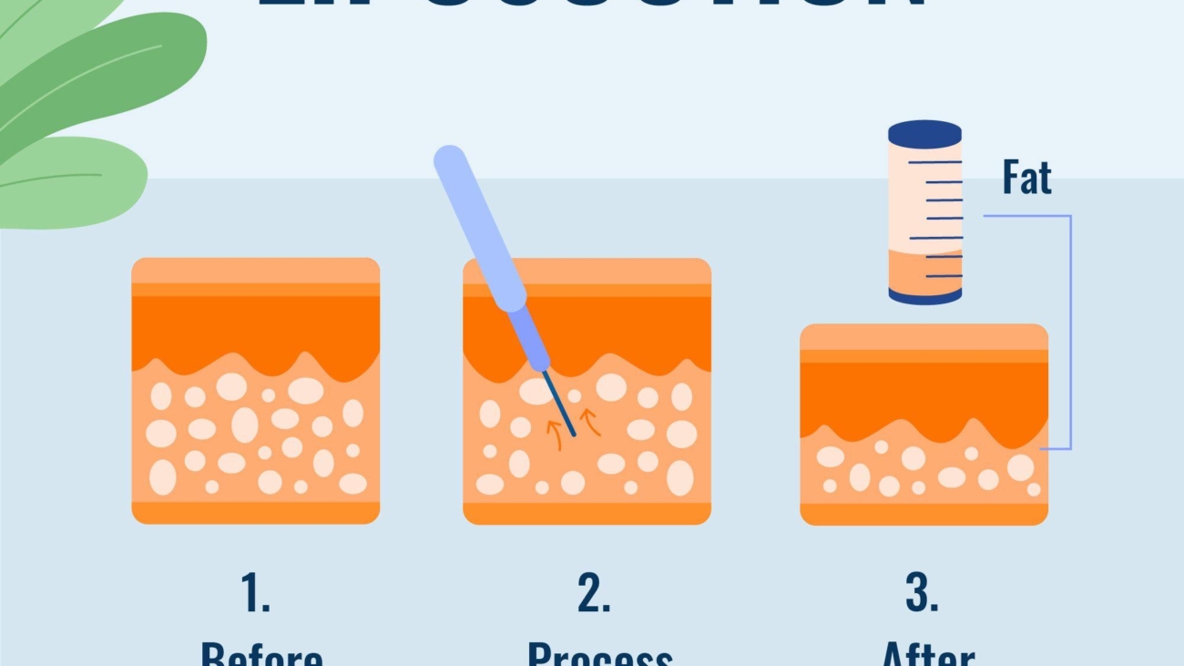 Is Liposuction Safe