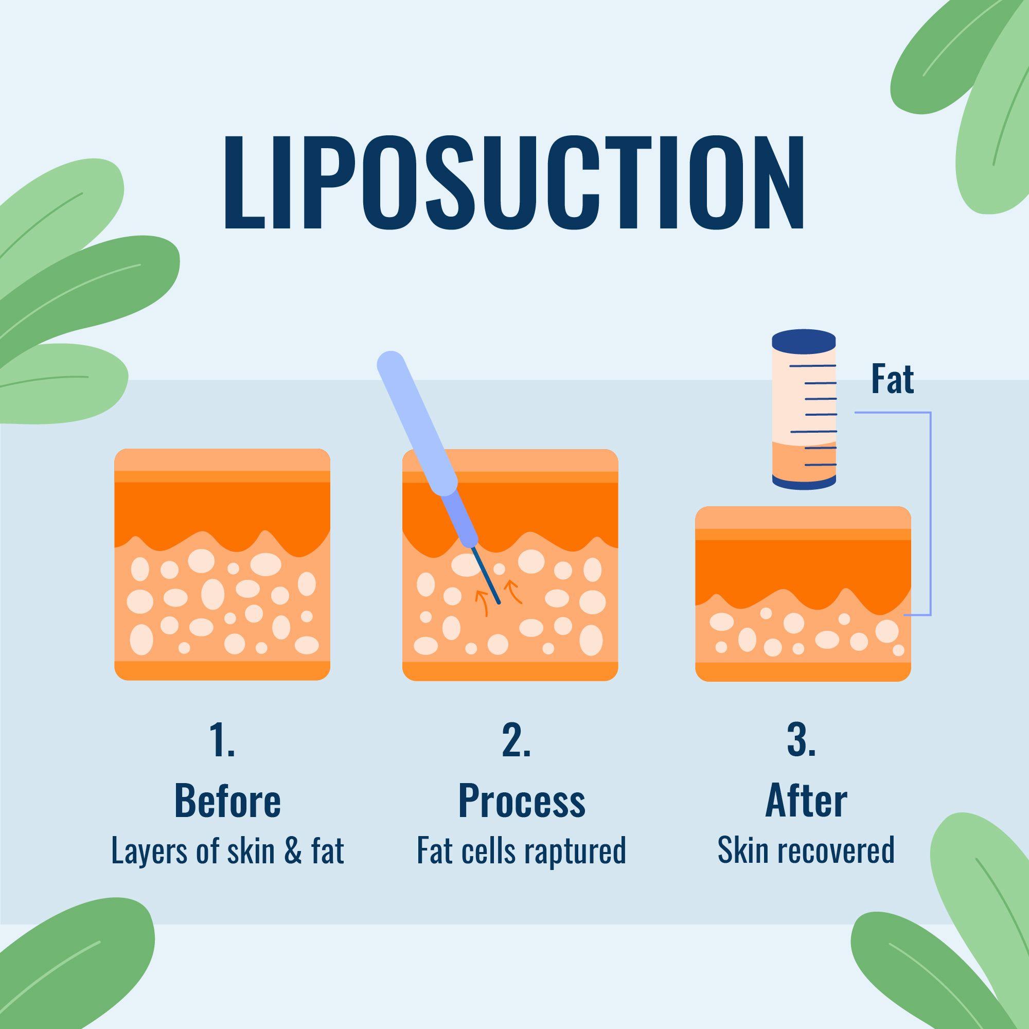 Is Liposuction Safe? Exploring the Risks and Benefits