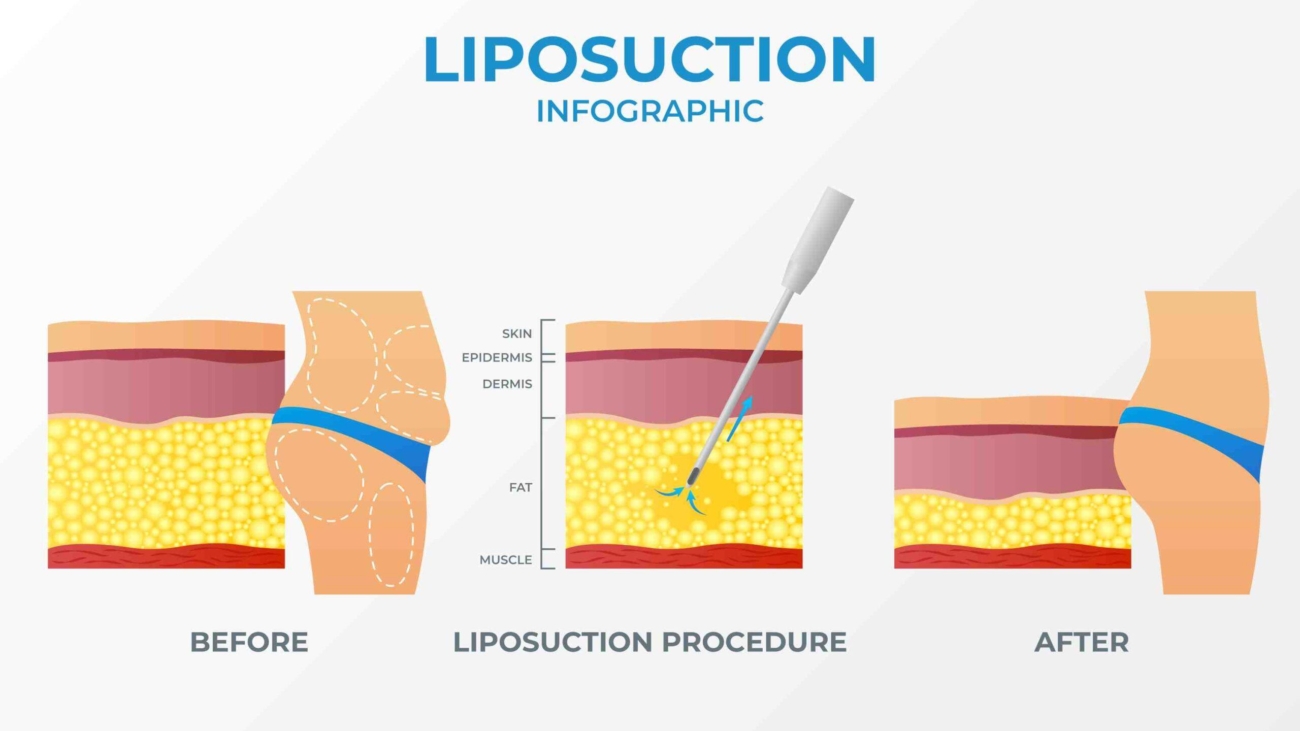 liposuction, tummy tuck, body contouring