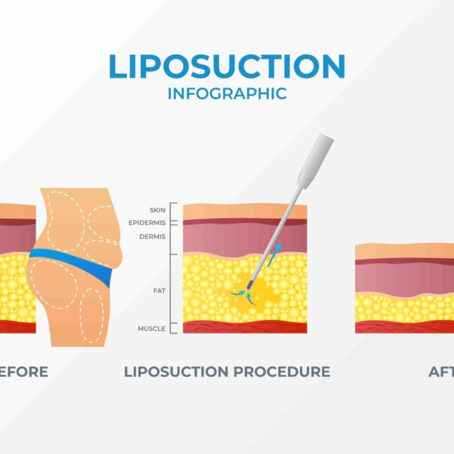 liposuction, tummy tuck, body contouring