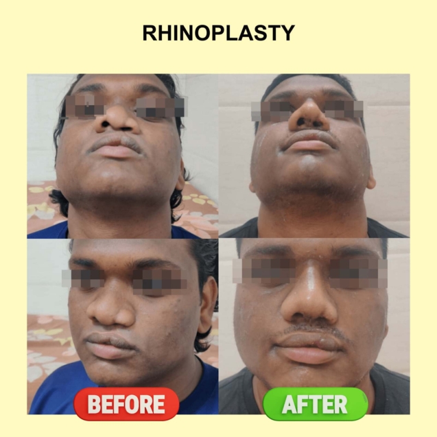 Rhinoplasty Overview Dr Service