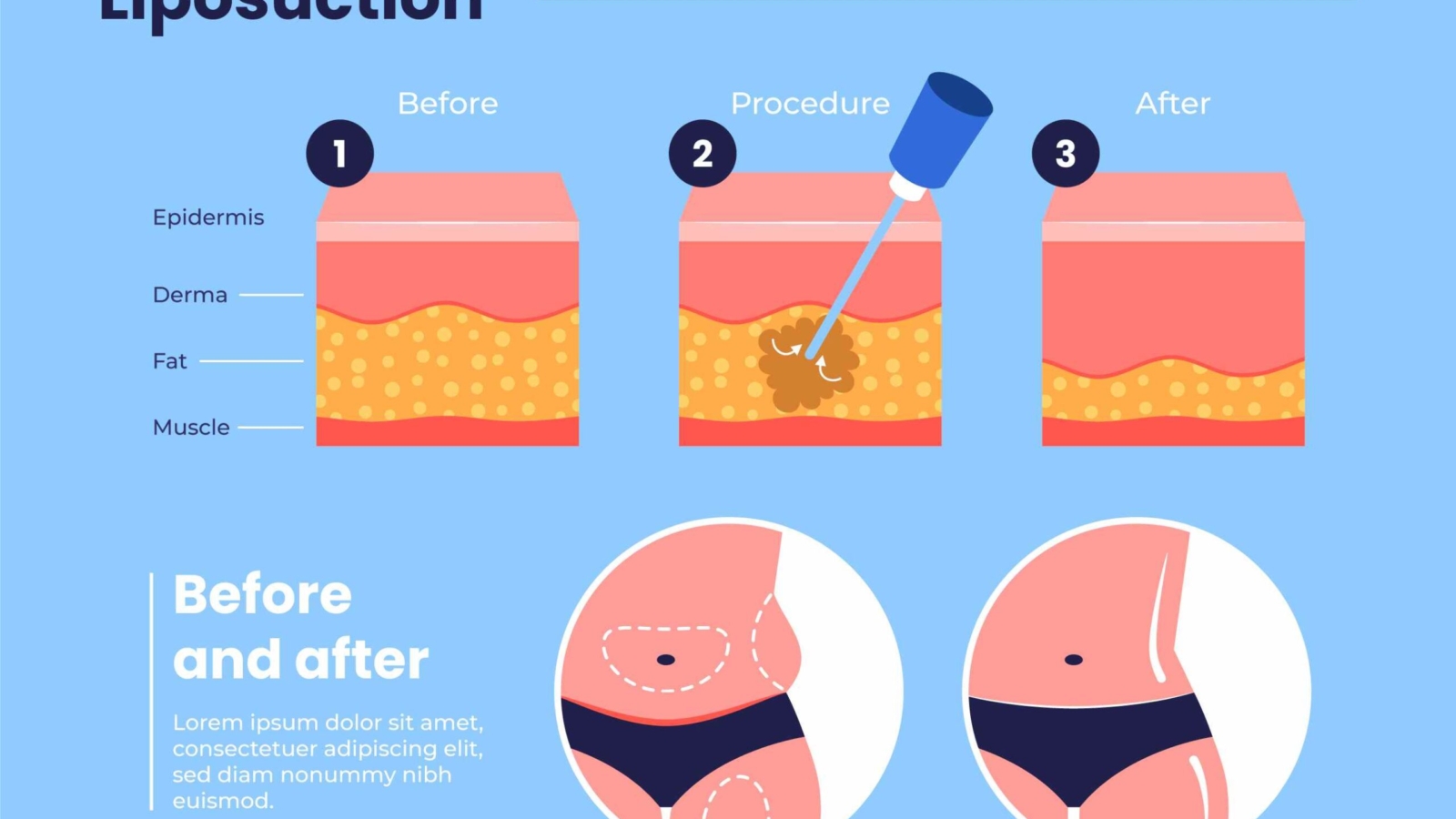 liposuction procedure