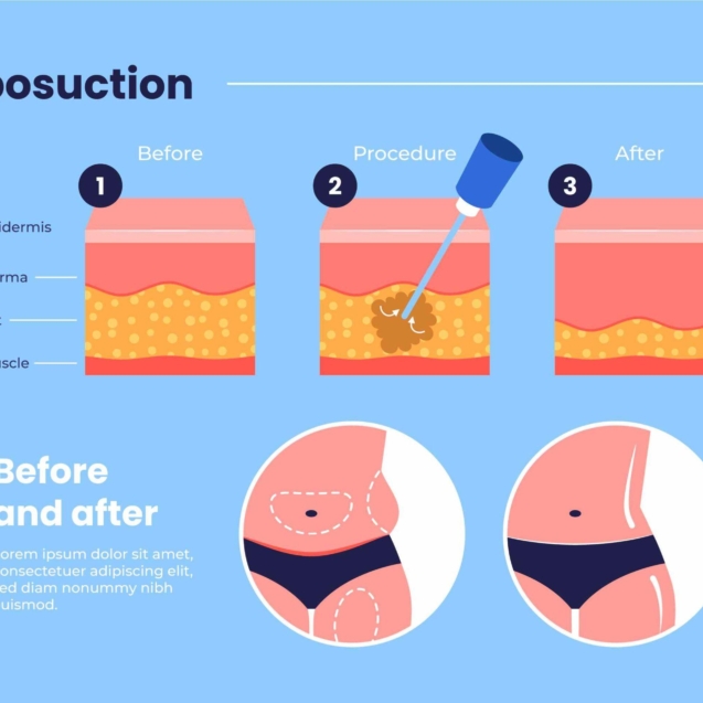liposuction procedure