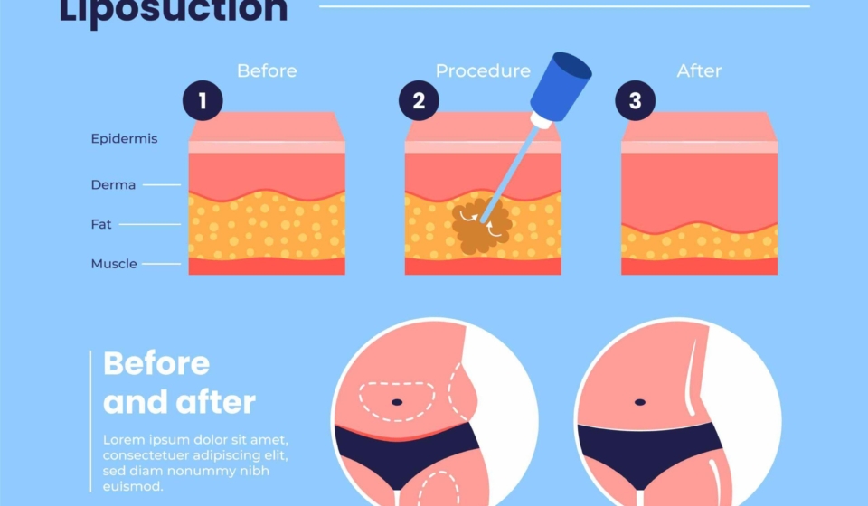 liposuction procedure
