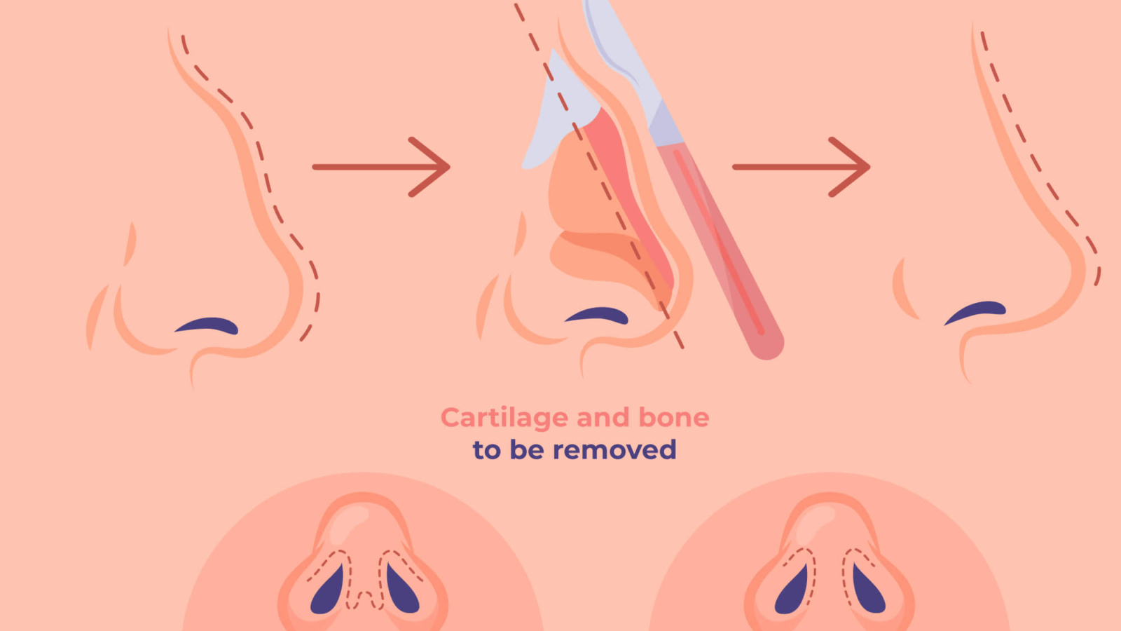 rhinoplasty surgery