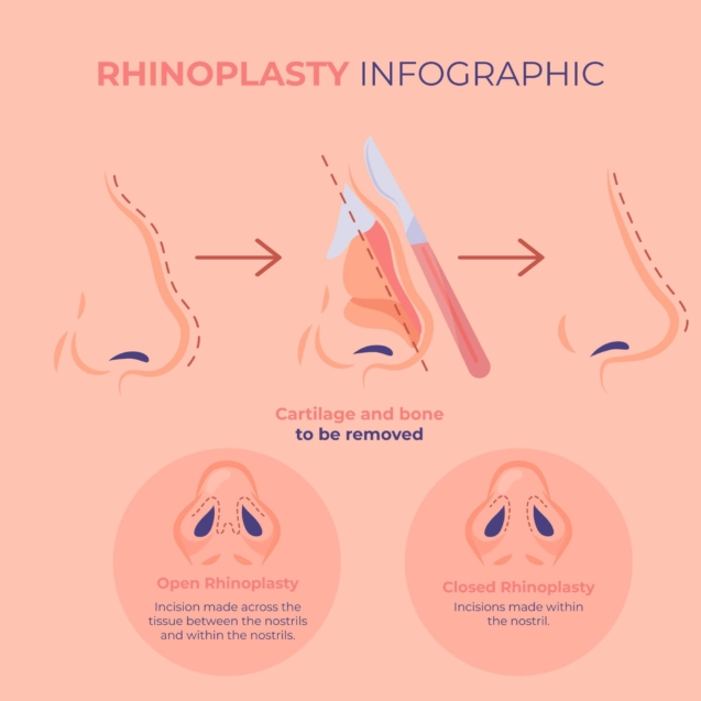 rhinoplasty surgery