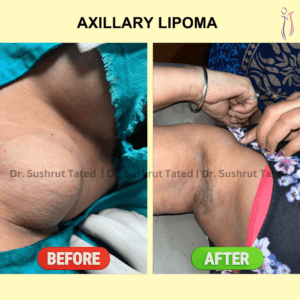 Axillary Lipoma
