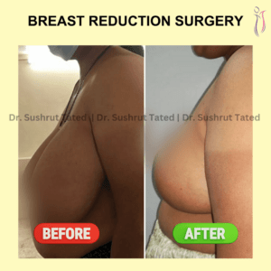 Breast Reduction Surgery