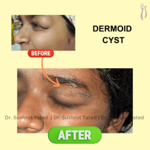 Dermoid Cyst