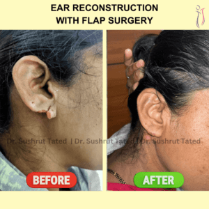 Ear Reconstruction with flap surgery