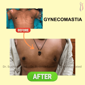 Gynecomastia