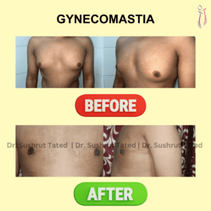 Gynecomastia