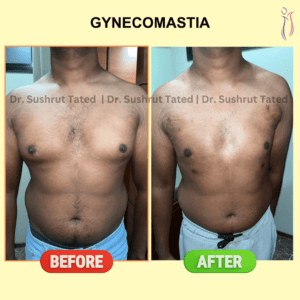 Gynecomastia