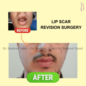 Lip Scar Revision Surgery
