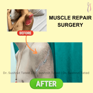 Muscle Repair Surgery