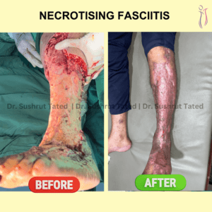 Necrotizing Faciitis