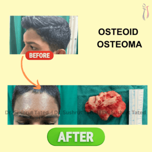 Osteoid Osteoma