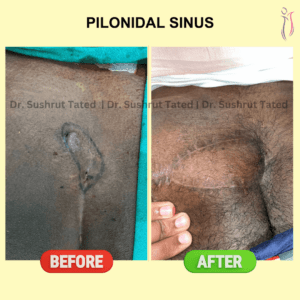 Pilonidal Sinus