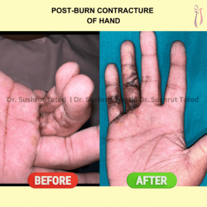 Post Burn Contracture of hand