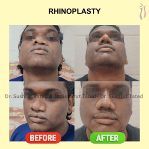 Rhinoplasty