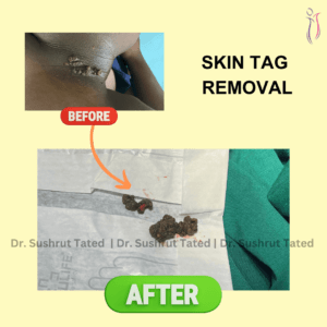 SKIN TAG Removal Nose Rhinoplasty Cyst