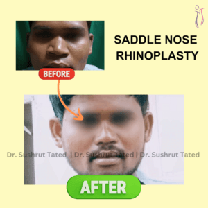 Saddle Nose Rhinoplasty