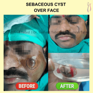 Sebaceous Cyst Over Face