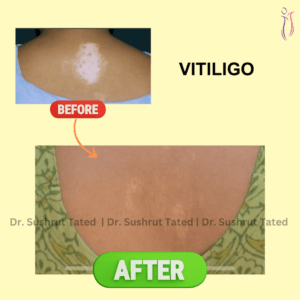 Vitiligo Surgery