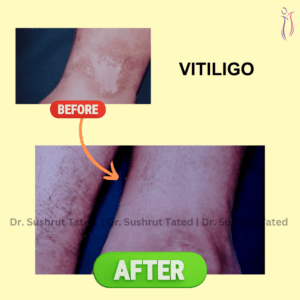 Vitiligo