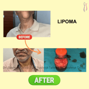 Lipoma