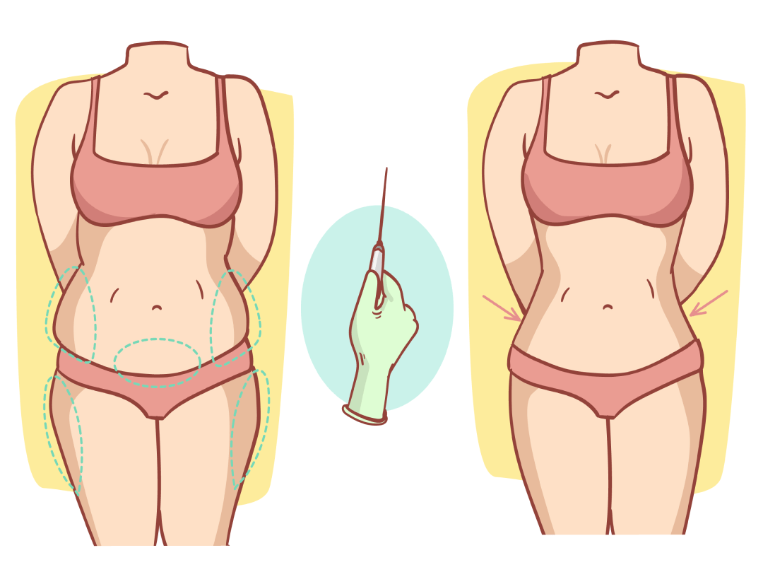 Liposuction Surgery
