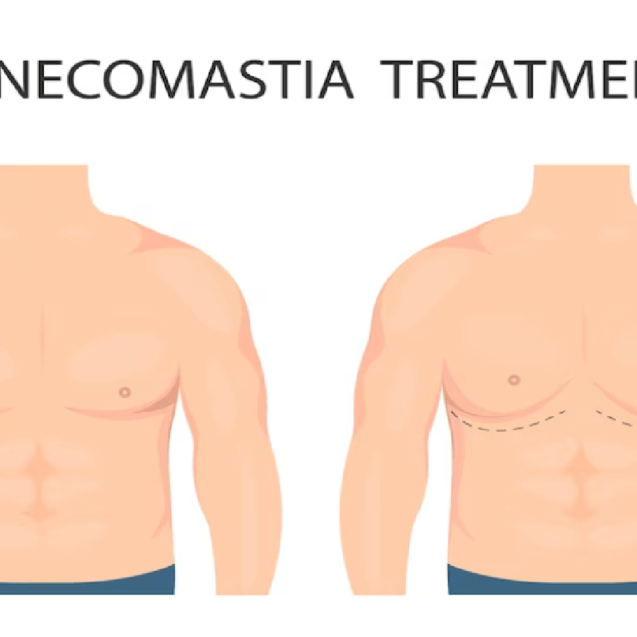 Gynecomastia Treatment
