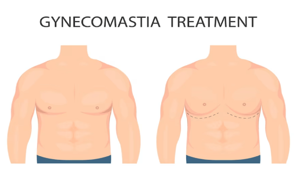Gynecomastia Treatment