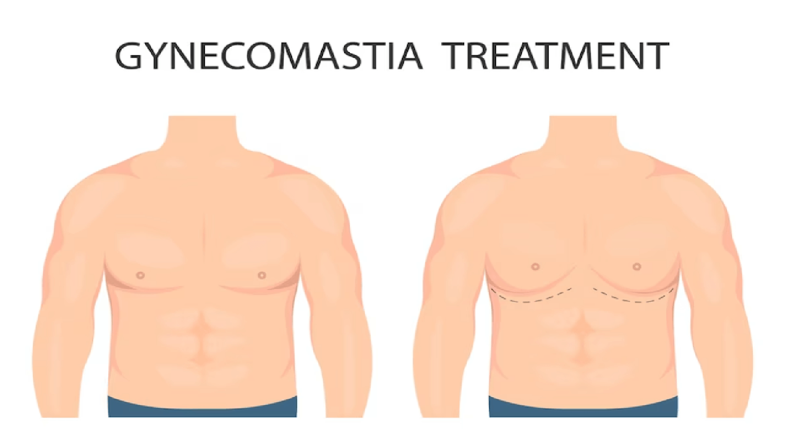 Unlocking Insights Comprehensive Guide to Surgery Costs in India