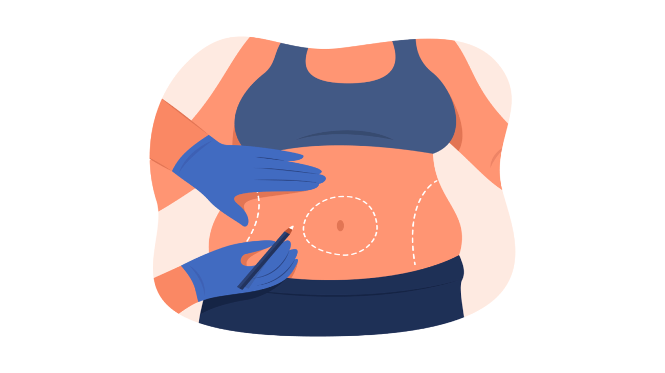 Tummy Tuck Surgery