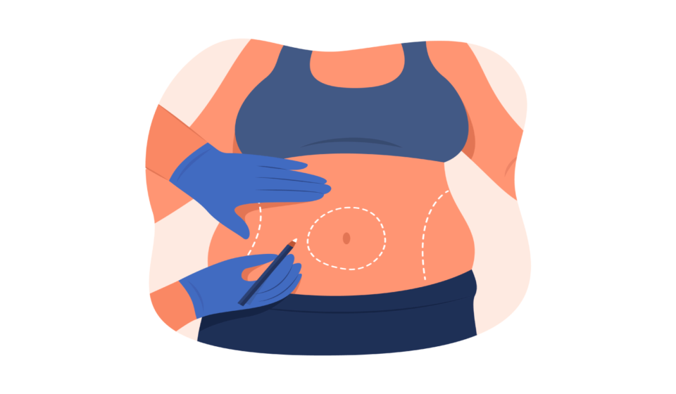 Tummy Tuck Surgery