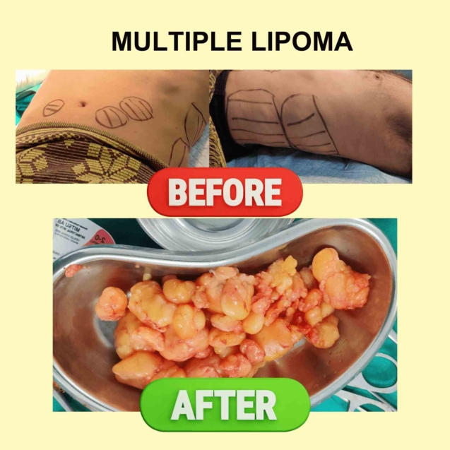 Multiple Lipoma