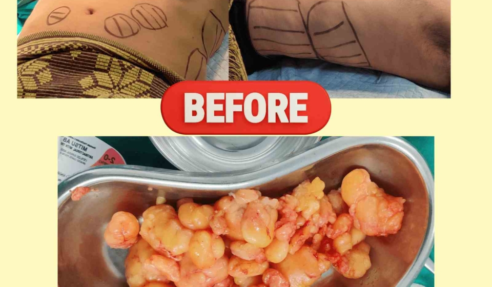 Multiple Lipoma