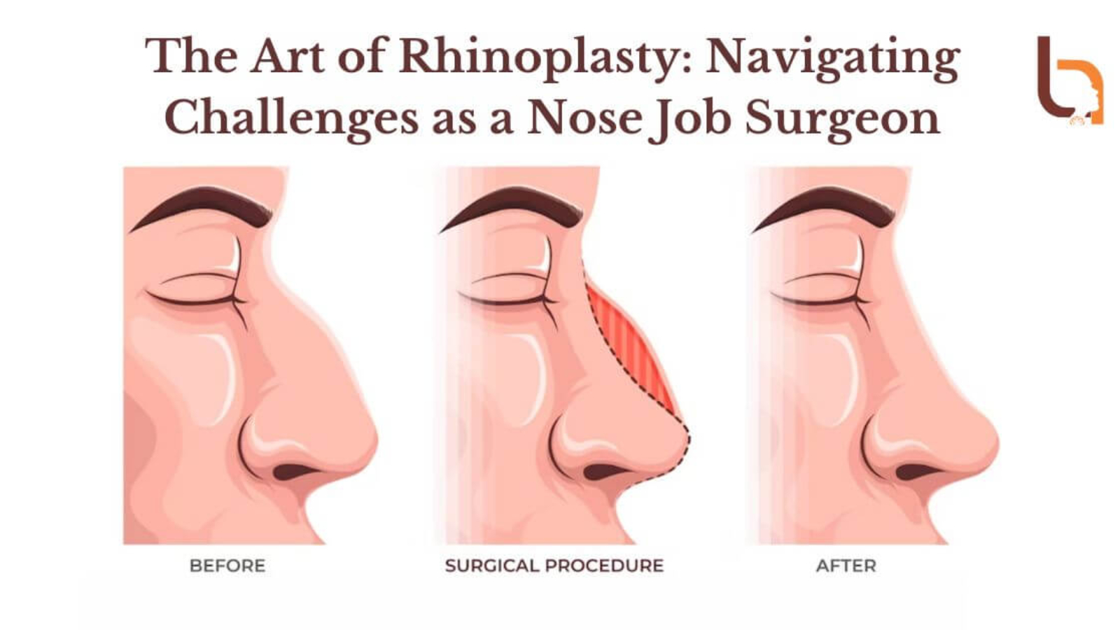 The-Art-of-Rhinoplasty-Navigating-Challenges-as-a-Nose-Job-Surgeon