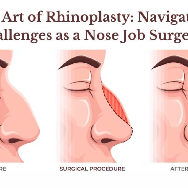 The-Art-of-Rhinoplasty-Navigating-Challenges-as-a-Nose-Job-Surgeon