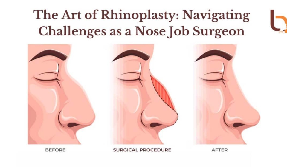 The-Art-of-Rhinoplasty-Navigating-Challenges-as-a-Nose-Job-Surgeon